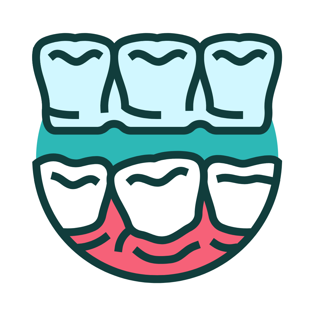 Illustration of teeth showing a dental bridge. Upper teeth are connected, lower teeth are individual, with red gums visible.