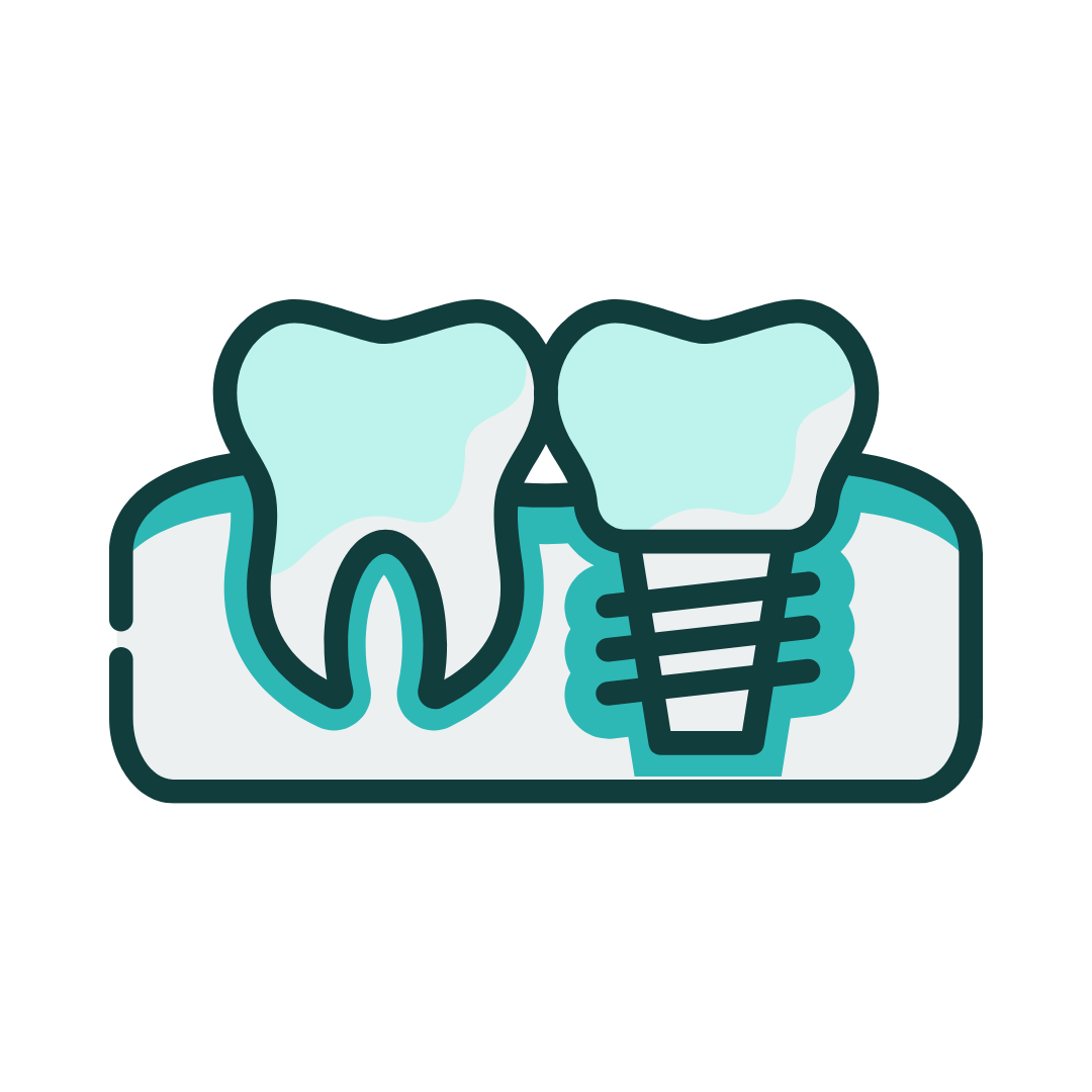Illustration of two teeth; one healthy, the other a dental implant. Both sit in light blue gums.
