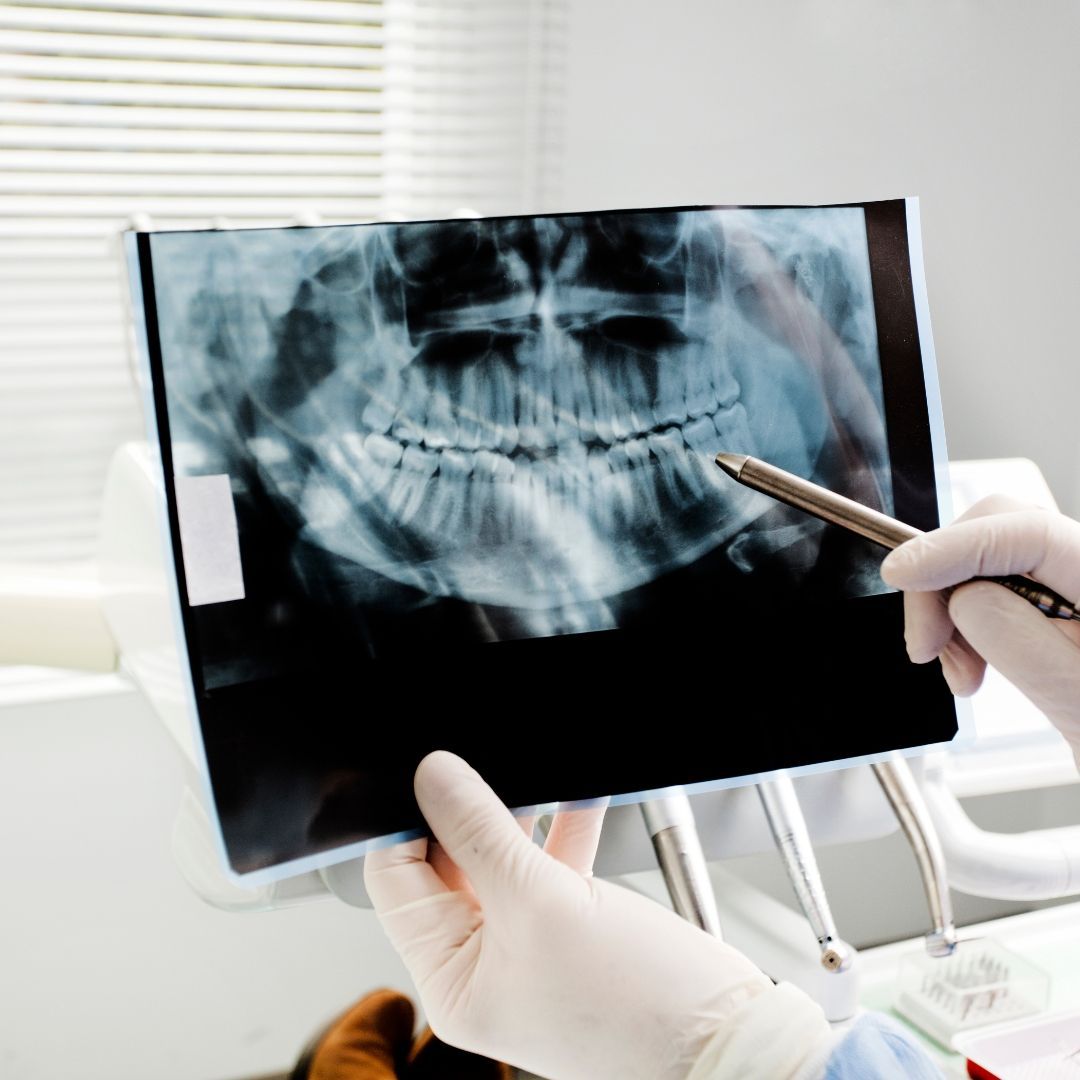 Hands in gloves holding and pointing to a dental X-ray showing teeth, in a dental office setting.