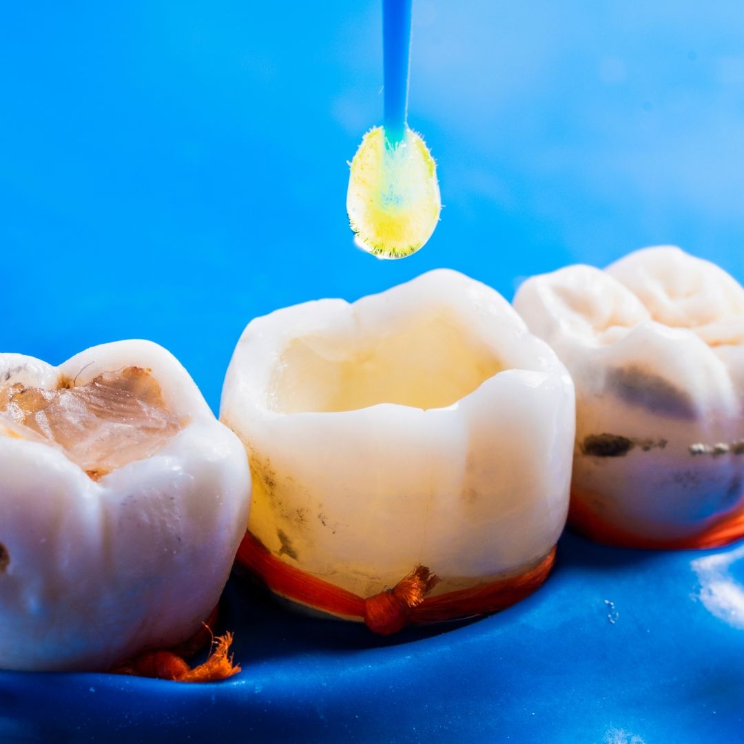 A dental procedure in progress: A tool applies yellow liquid to a prepared tooth with a large cavity, among two other teeth on a blue background.