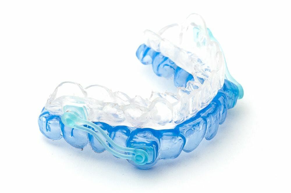 A blue and clear dental appliance designed for snoring or sleep apnea, resting on a white surface.
