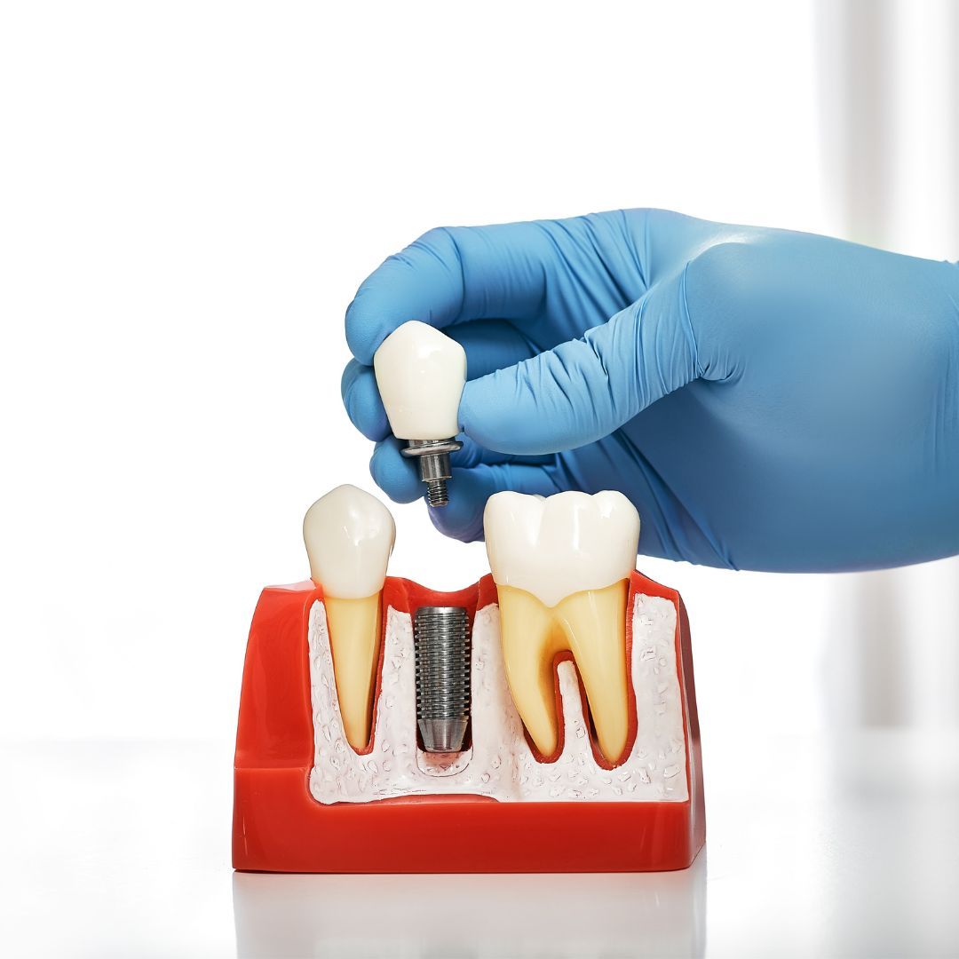 Gloved hand placing a tooth crown onto a dental implant model. The model shows a cross-section of teeth and gums.