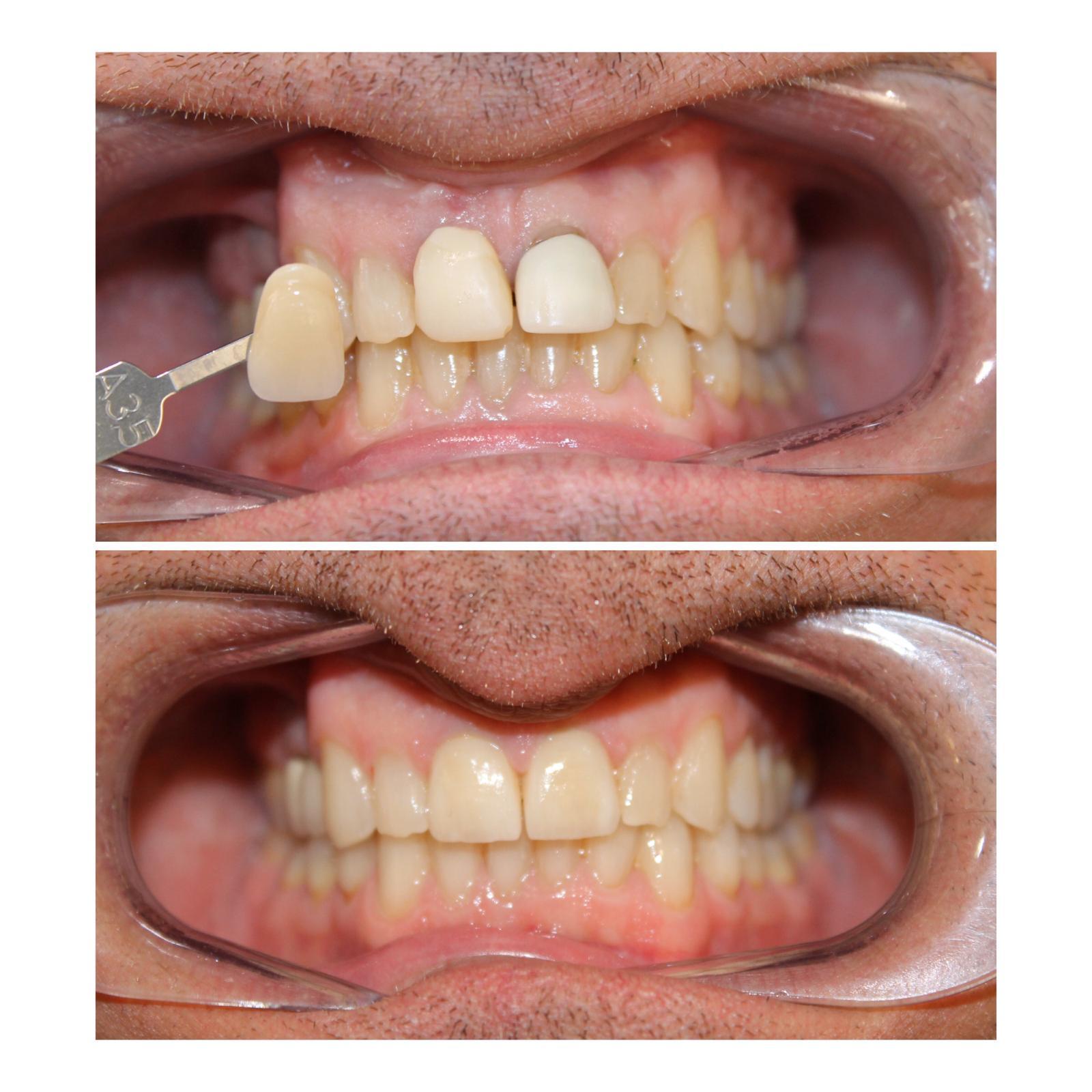 before and after teeth photo