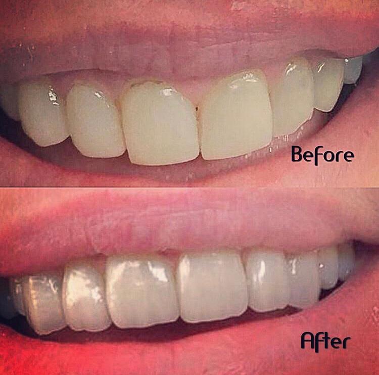 before and after teeth photo