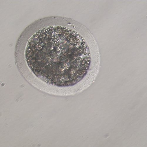 Unfertilized oocyte (commonly called UFO) with a sperm cell adhered to the zona pellucida. UFOs are commonly flattened, but this one was still spherical but degenerated ooplasm marks it as a UFO.