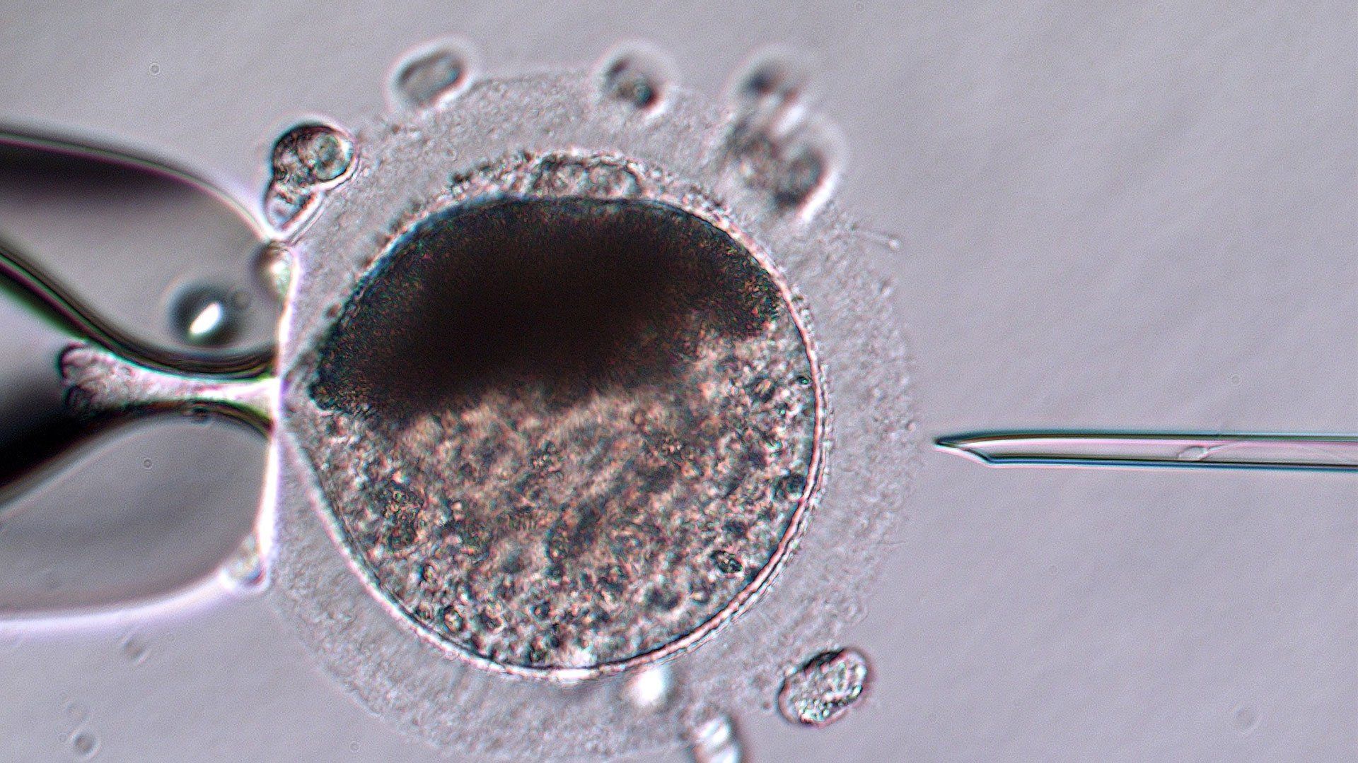 Oocytes (eggs) are collected from follicles on the ovaries by transvaginal follicular aspiration (TVA), also called ovum pickup (OPU).