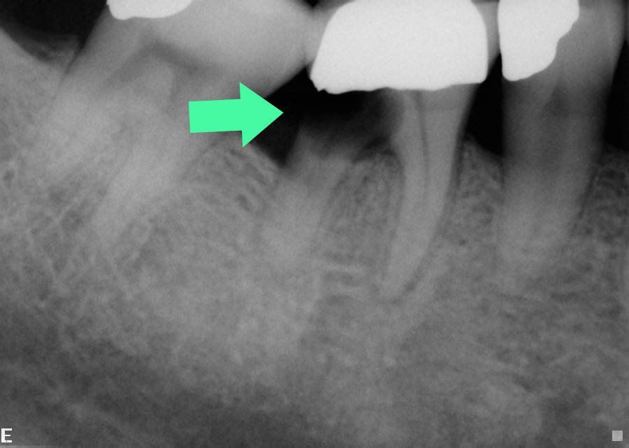 tooth decay xray