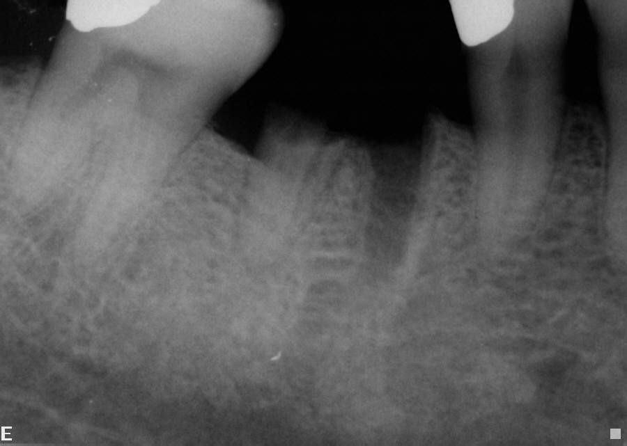 The following X-ray shows the area after the tooth was extracted - Stuparich & Nouel Dental Associates