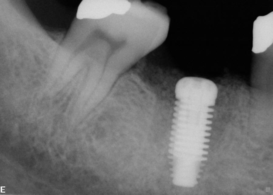 The following xray was taken after the implant was placed - Stuparich & Nouel Dental Associates