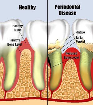 healthy teeth and periodontal disease