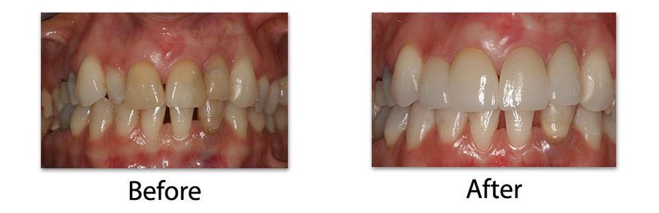 Before and after of patients mouth - Stuparich & Nouel Dental Associates