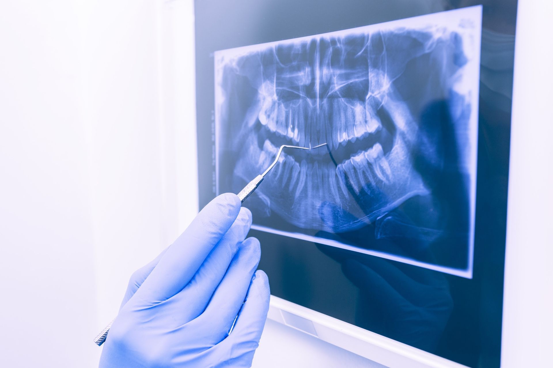 Insights Into Dental Xrays Unveiling The Importance And Safety Measures