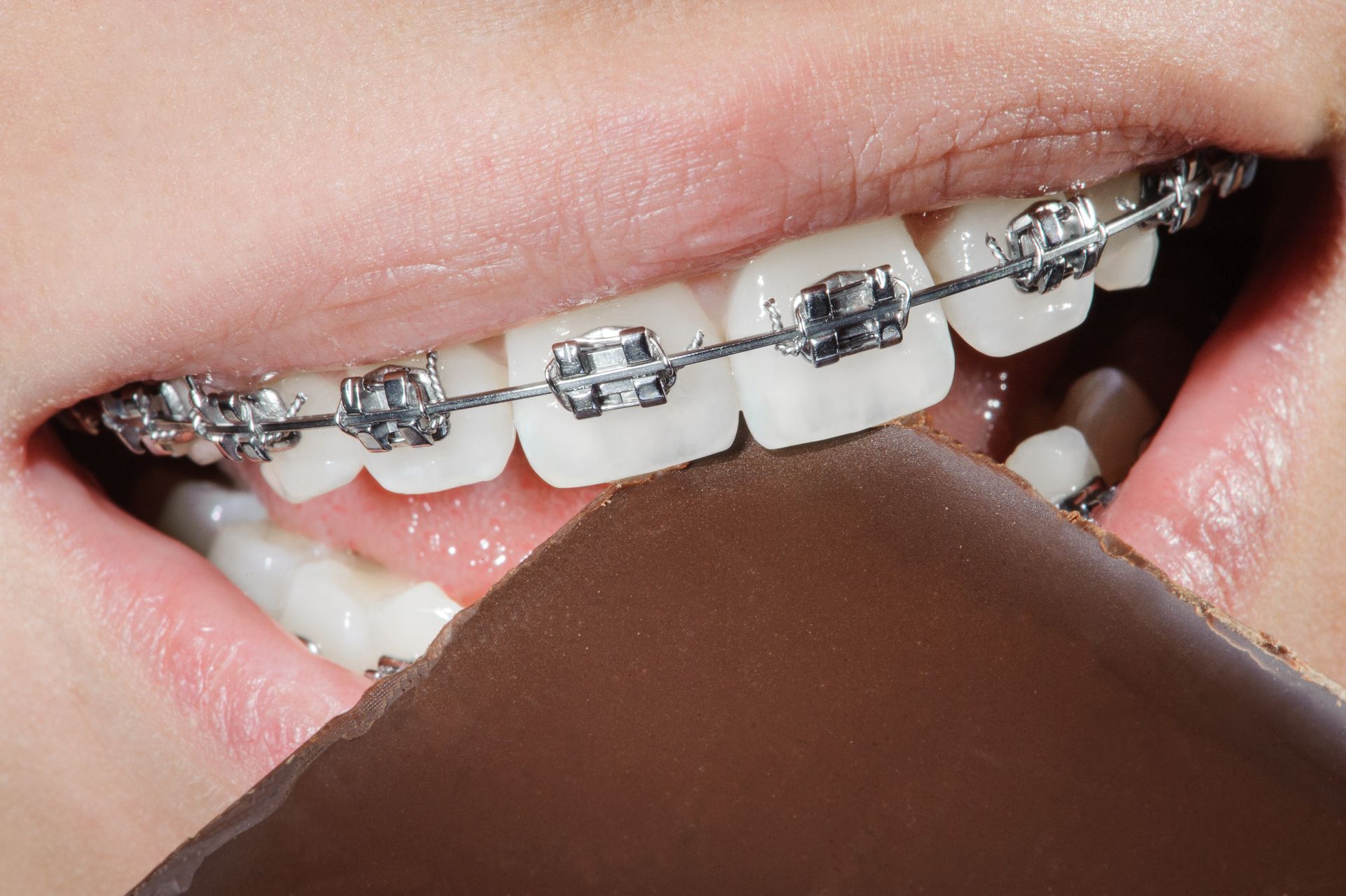 Braces for Adults Is It Ever Too Late To Get Straight Teeth?