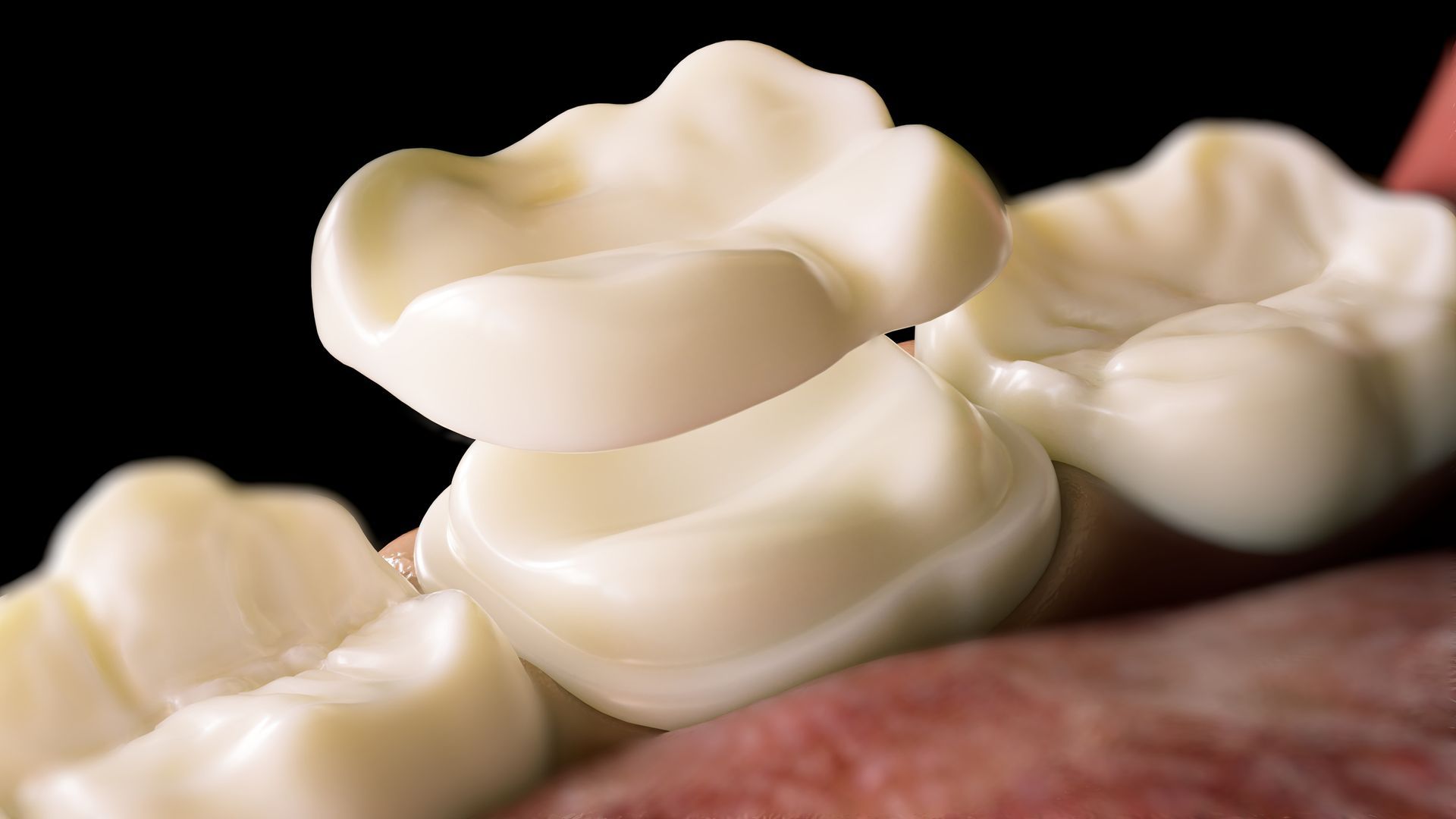 Porcelain Dental Crown Over Tooth