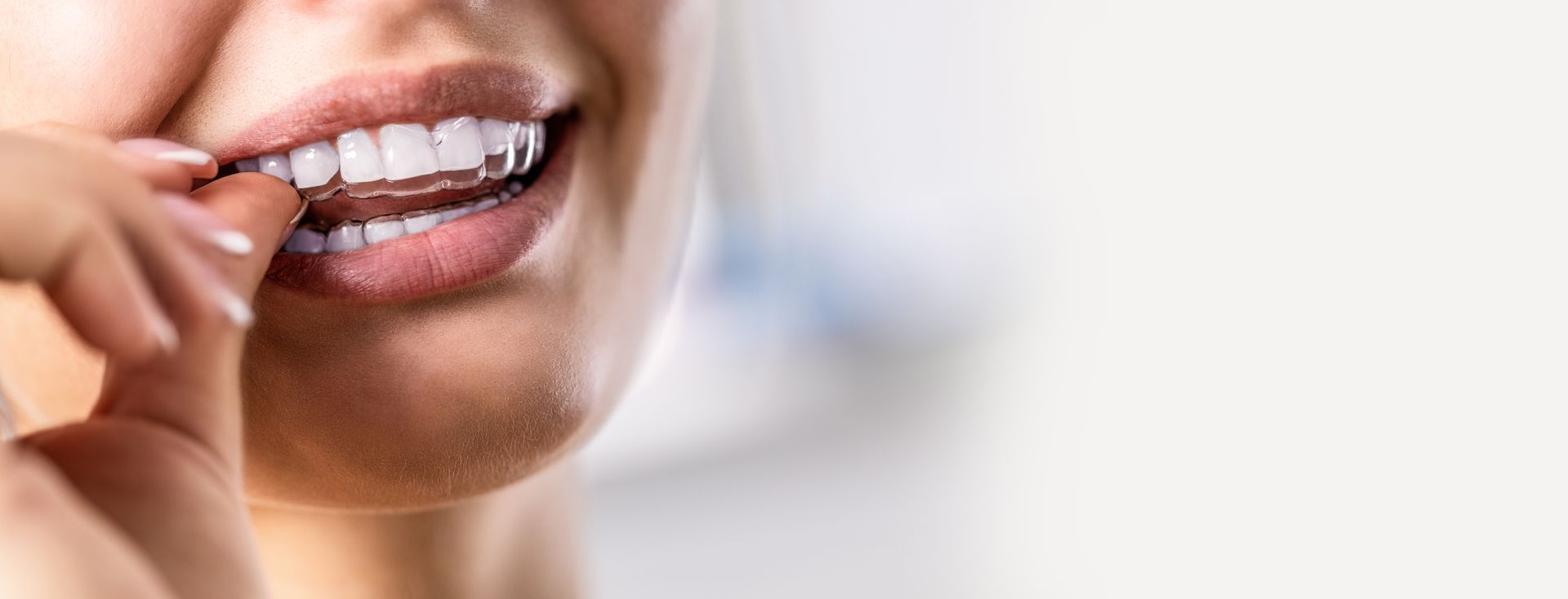 Woman Using Invisalign Retainers to Straightening Teeth,