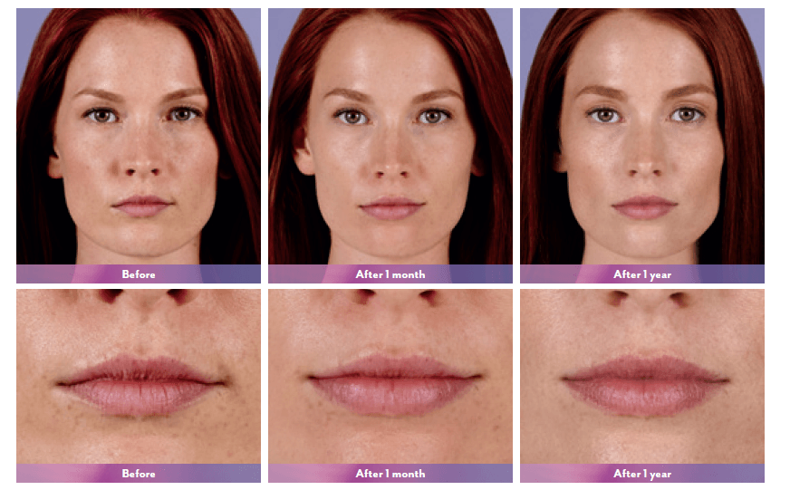 Dermal Fillers in Jacksonville, FL