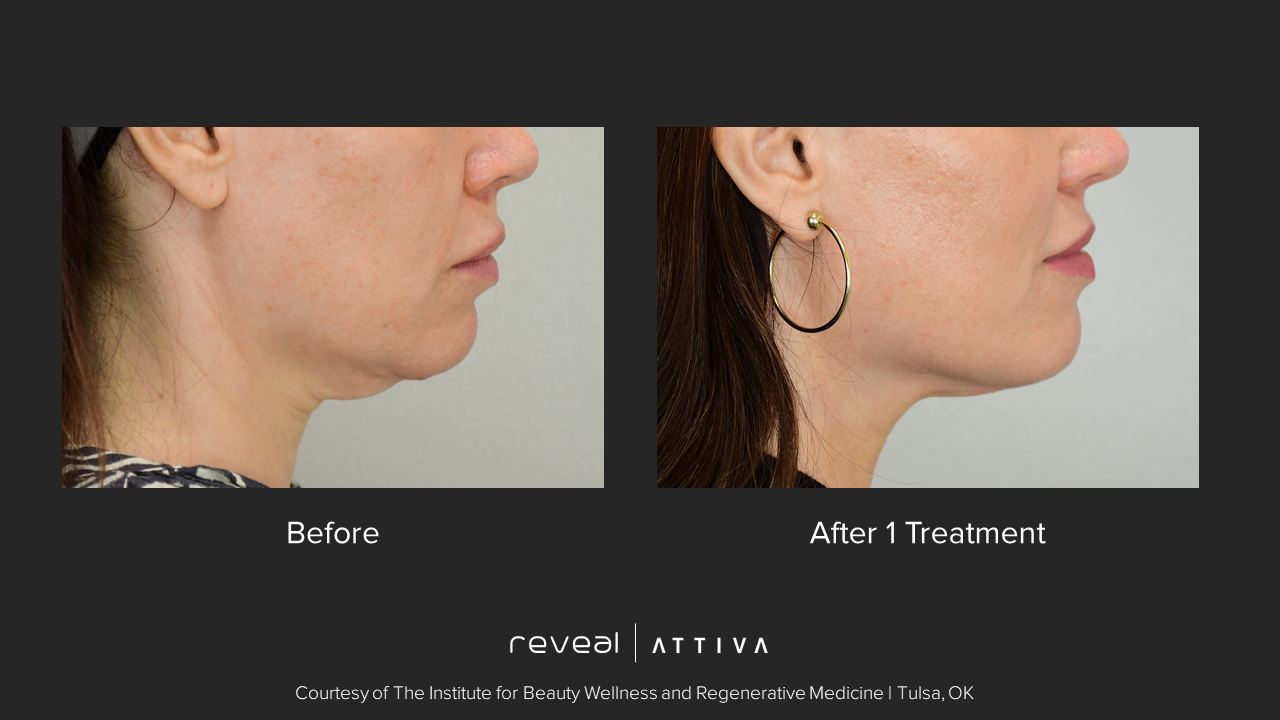 A before and after photo of a woman 's face with hoop earrings.  – Ponte Vedra Beach, FL – Ponte Vedra Vein Institute