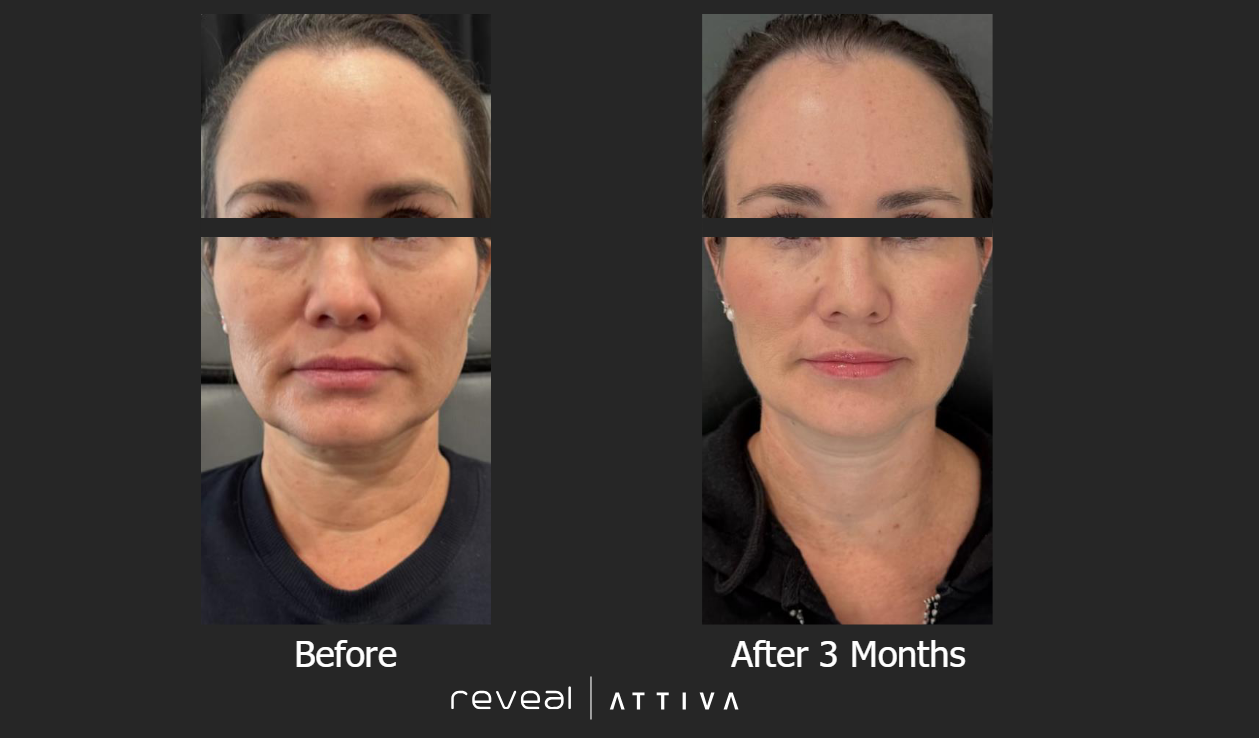 A before and after photo of a woman 's face – Ponte Vedra Beach, FL – Ponte Vedra Vein Institute