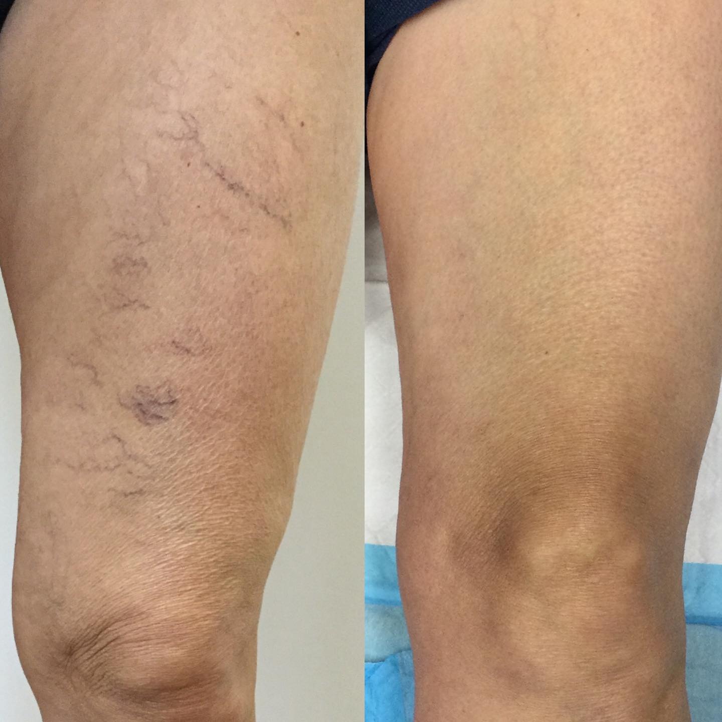 Spider Vein Treatments Jacksonville Fl And Ponte Vedra Fl 6551