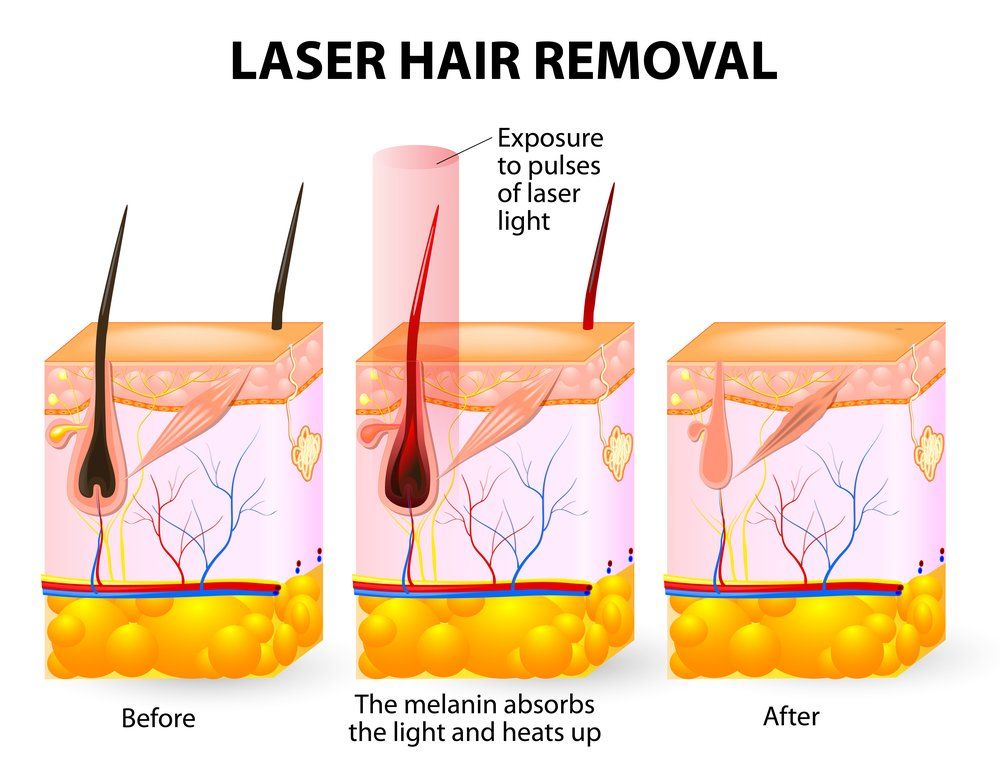 Laser Hair Removal — Ponte Vedra Beach, FL — Ponte Vedra Vein Institute