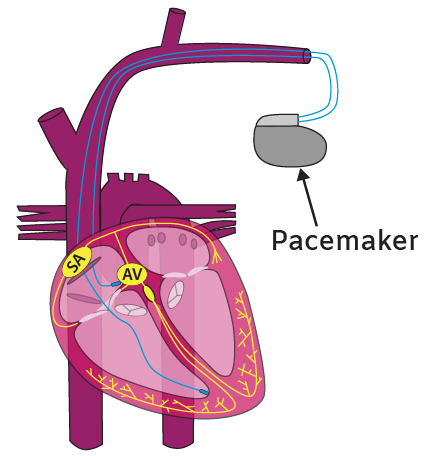 Heart pacemaker illustration
