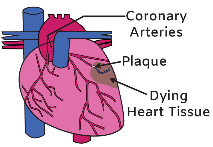 Heart attack illustration with arteries and dying tissue