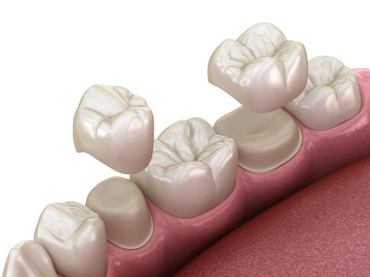 Dental crowns being placed on prepared teeth in a mouth; showing white crowns, pink gums, and teeth.