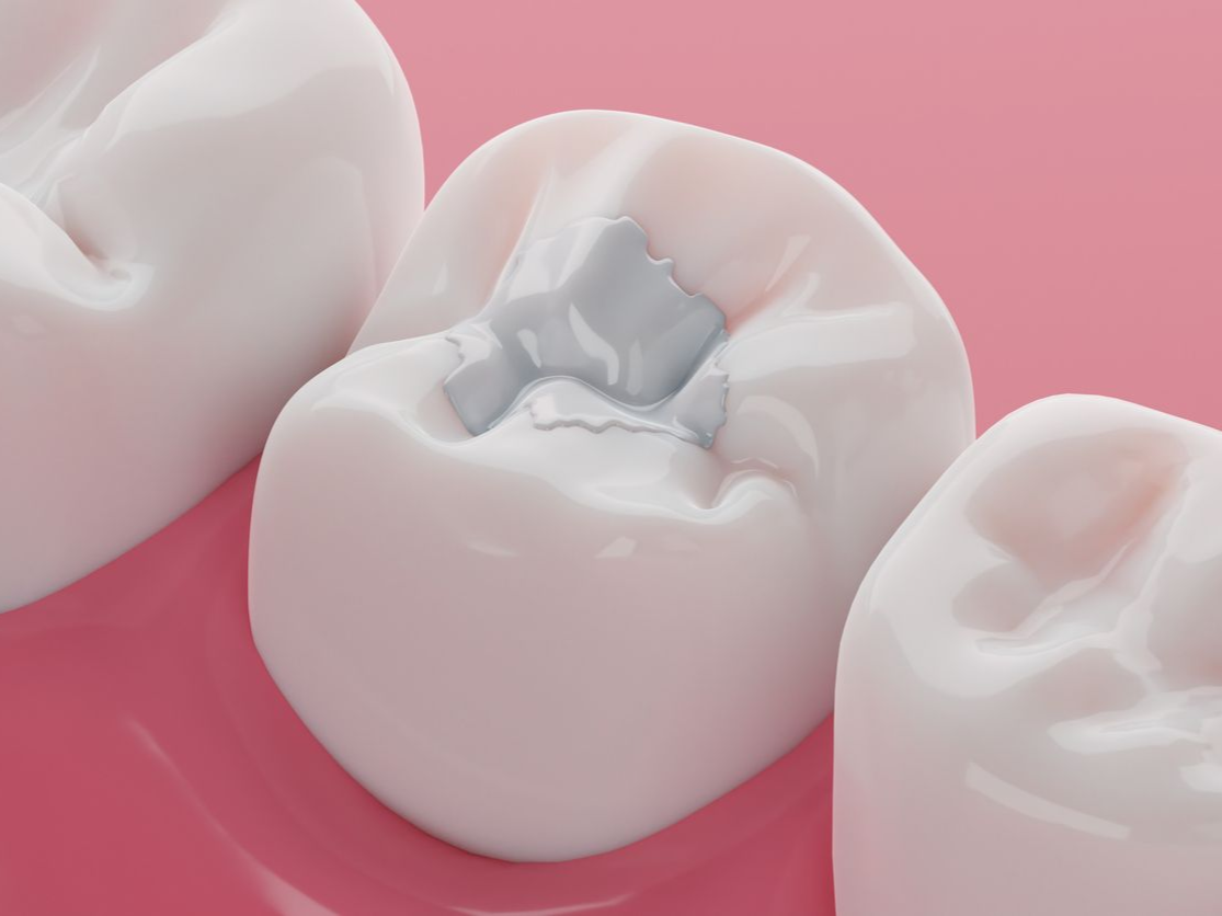 Tooth with silver filling in pink gum setting.