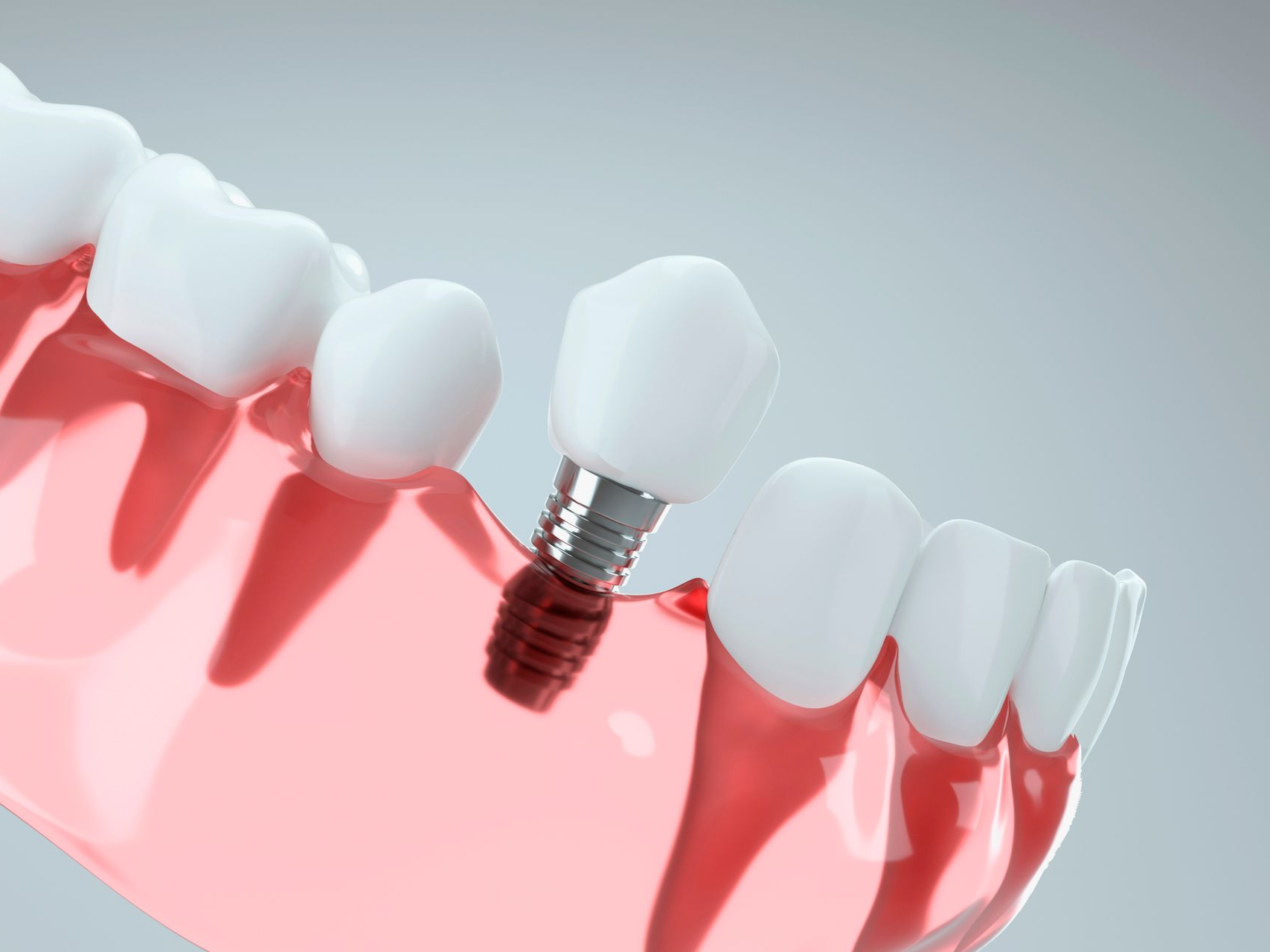 Dental implant model shows a white crown on a metal screw in the pink gum, replacing a missing tooth.
