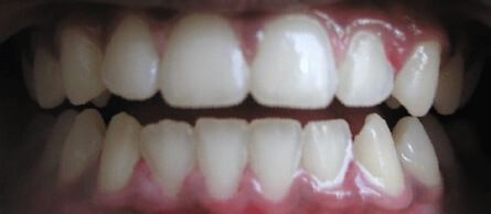 After Image of a mouth with straight teeth and no silver filing