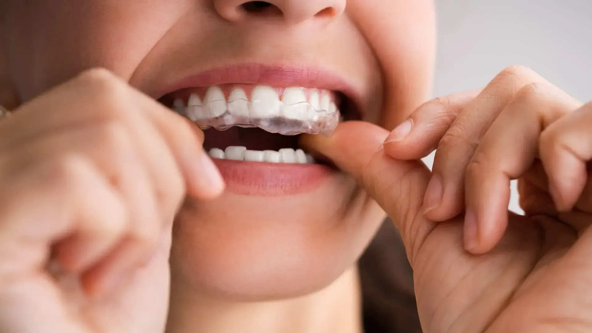 A woman is putting invisible braces on her teeth.