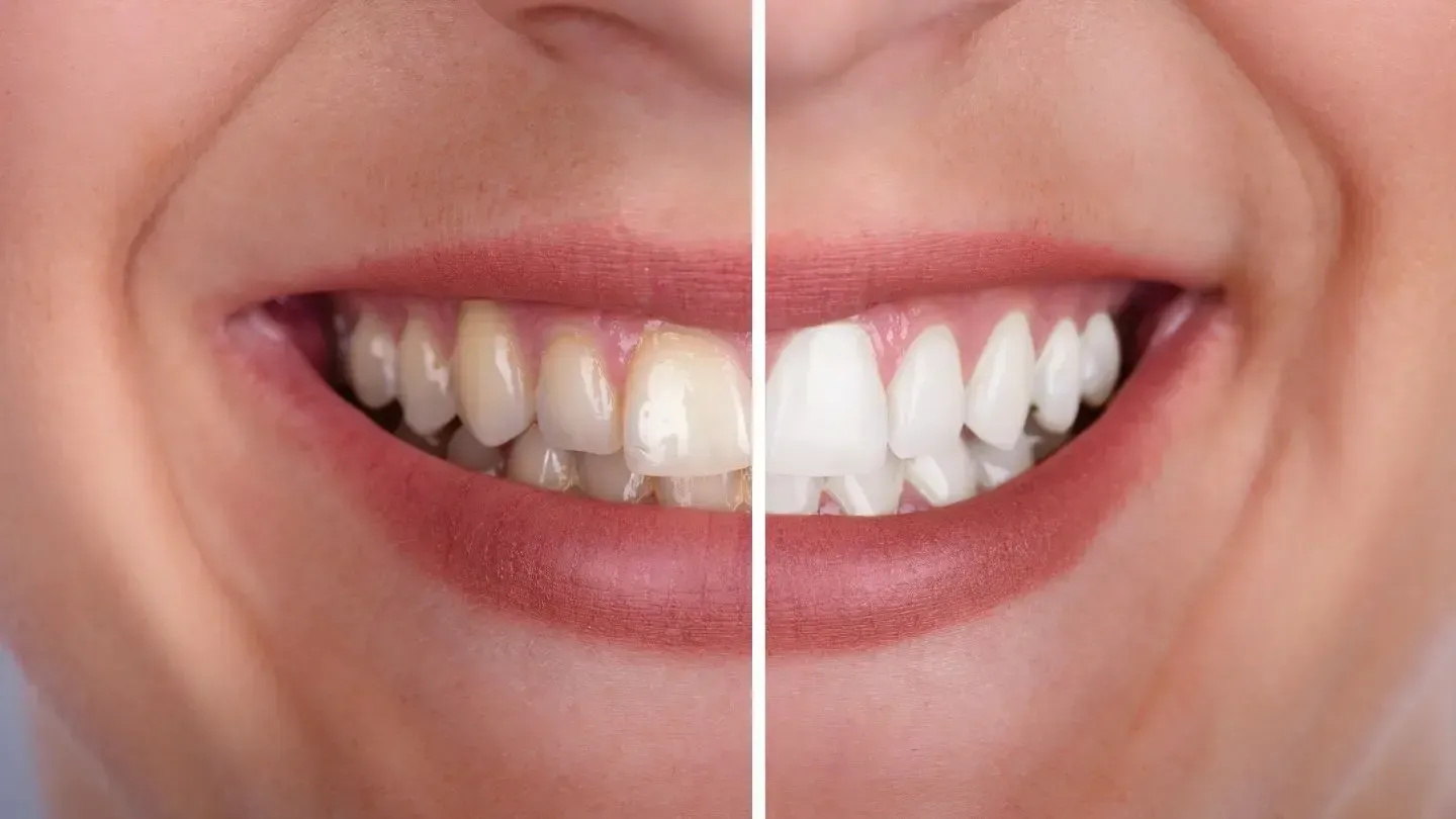 Comparison of teeth before and after whitening, showing a woman's smile with yellowish teeth on the left and bright white teeth on the right.
