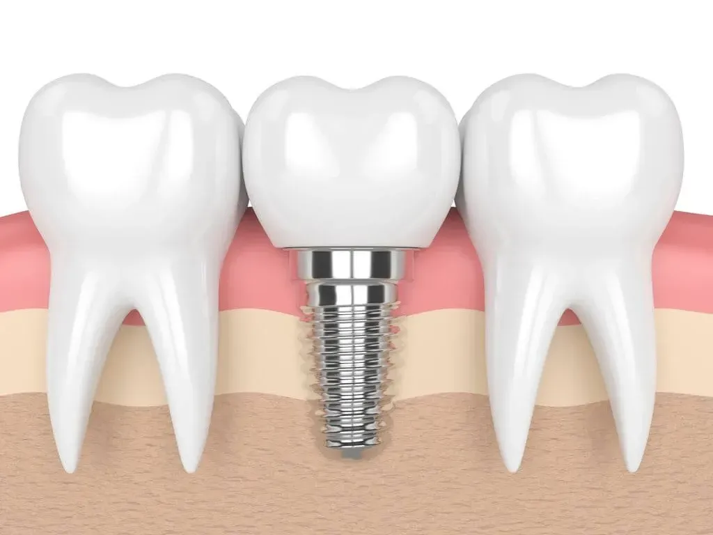 three teeth with a dental implant in the middle