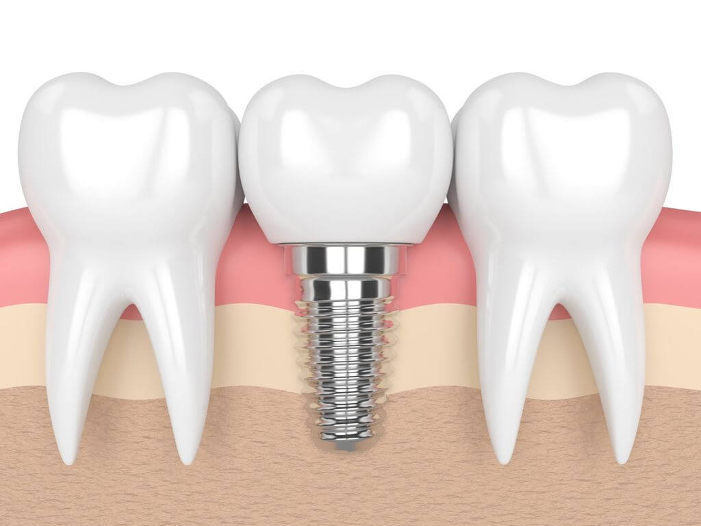 three teeth with a dental implant in the middle