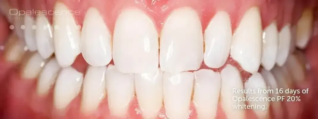 Bright White Teeth Before Professional Teeth Whitening