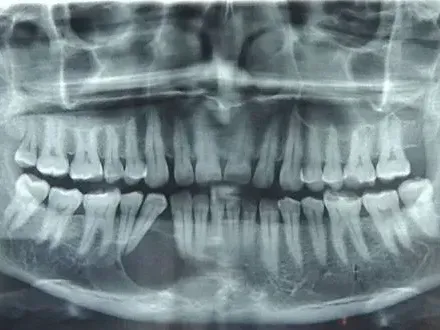 It is an x-ray of a person 's teeth.