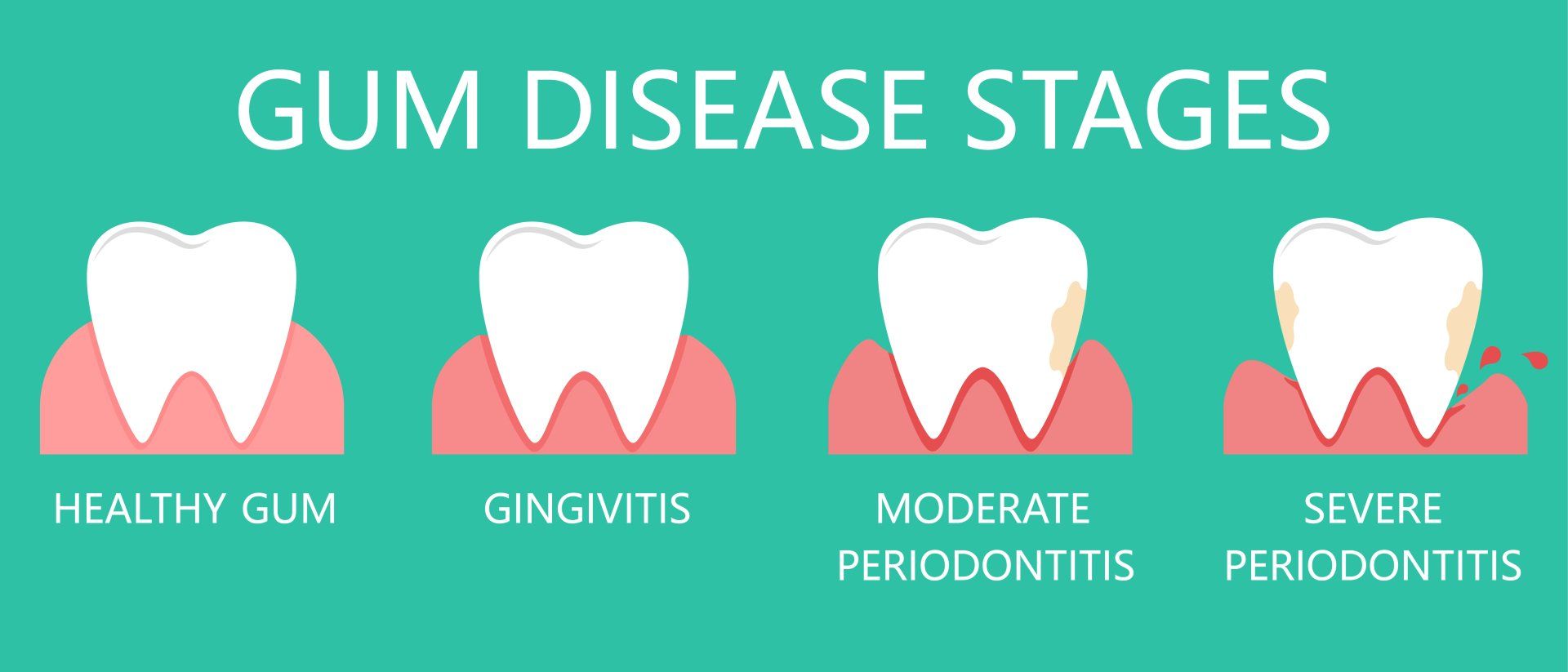 Graphic image showing gum disease stages - Duxton Dental