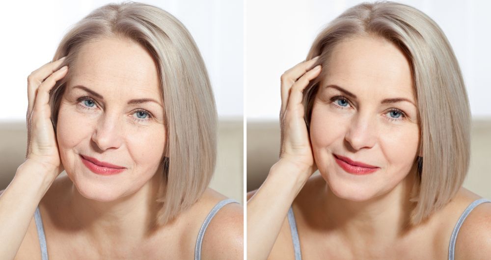 Side-by-side comparison of woman's face, showing wrinkles before and after smoothing treatment.