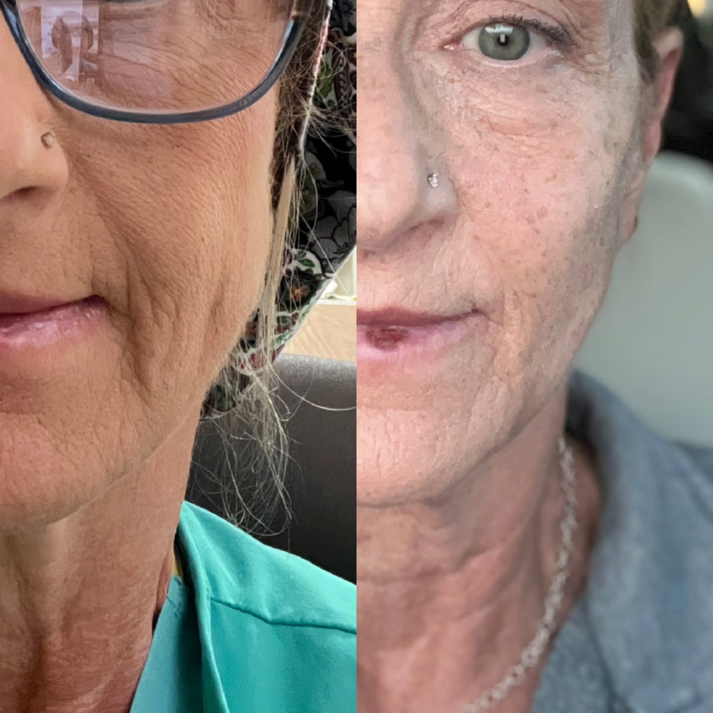 Side-by-side comparison of a person's face. One side shows more wrinkles, the other side shows smoother skin.