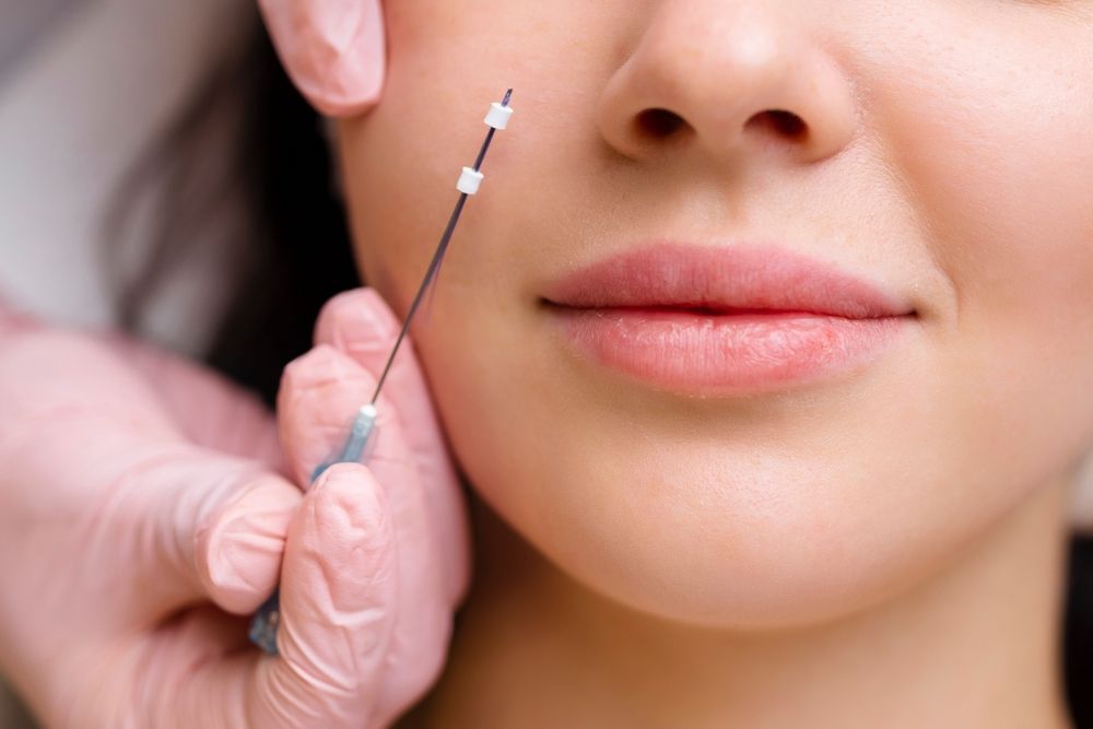 Person receiving a thread lift treatment on their cheek. A needle is being inserted.