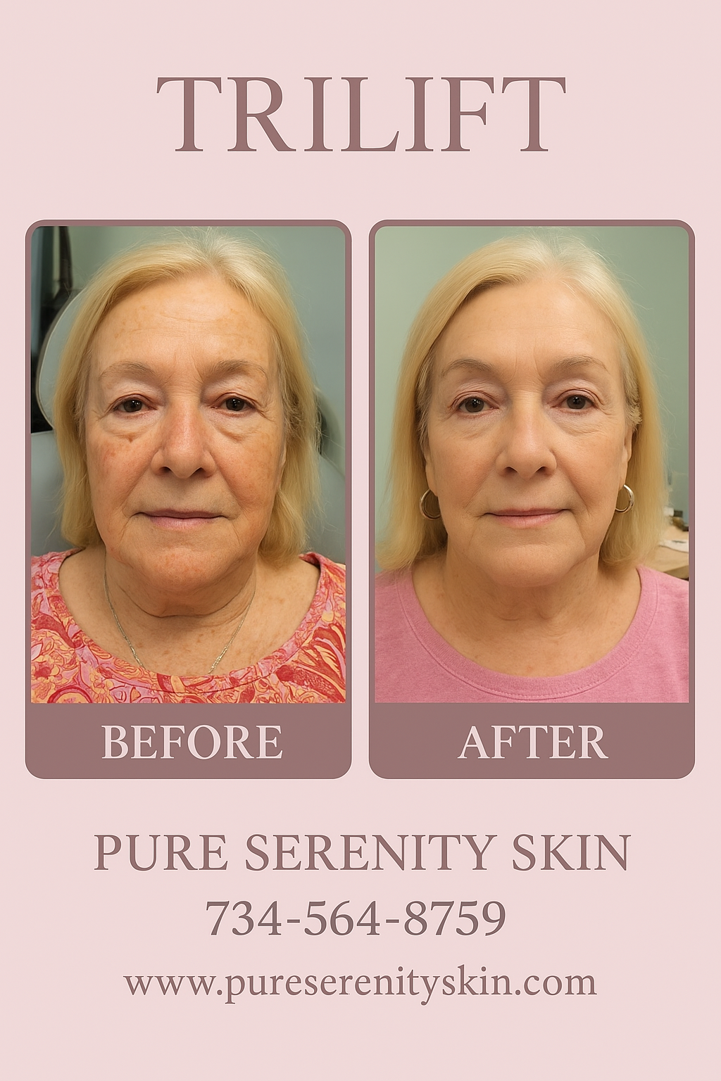 Before and after photos of a woman's face, showing a skin tightening treatment. The