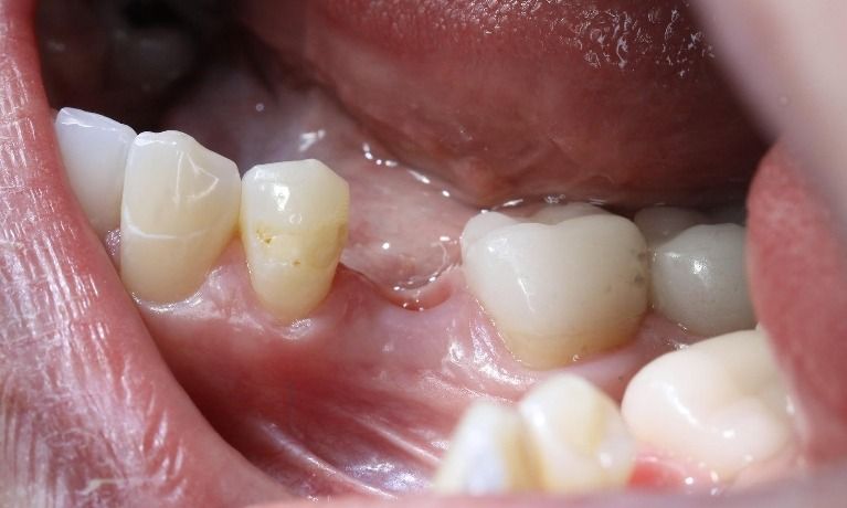 Close-up of a person's open mouth, showing teeth and gums. A missing tooth is visible.