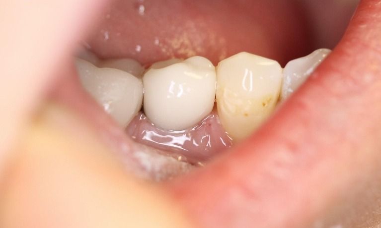 Close-up of a person's mouth, showing white teeth and pink gums. One tooth appears to be capped.