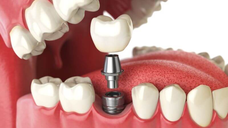 Dental implantation