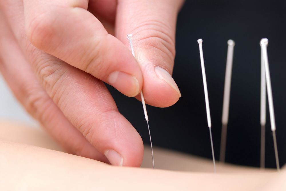 A Person Is Getting Acupuncture On Their Back — Resonance Health Studio in Wauchope, NSW
