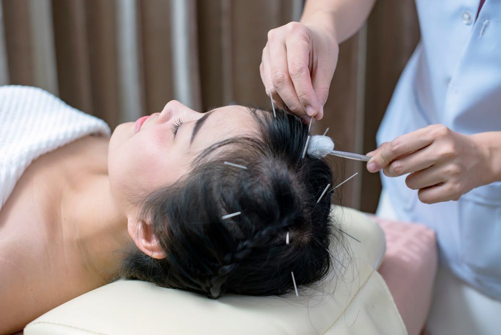 A Woman Is Getting Acupuncture Treatment On Her Head — Resonance Health Studio in Wauchope, NSW