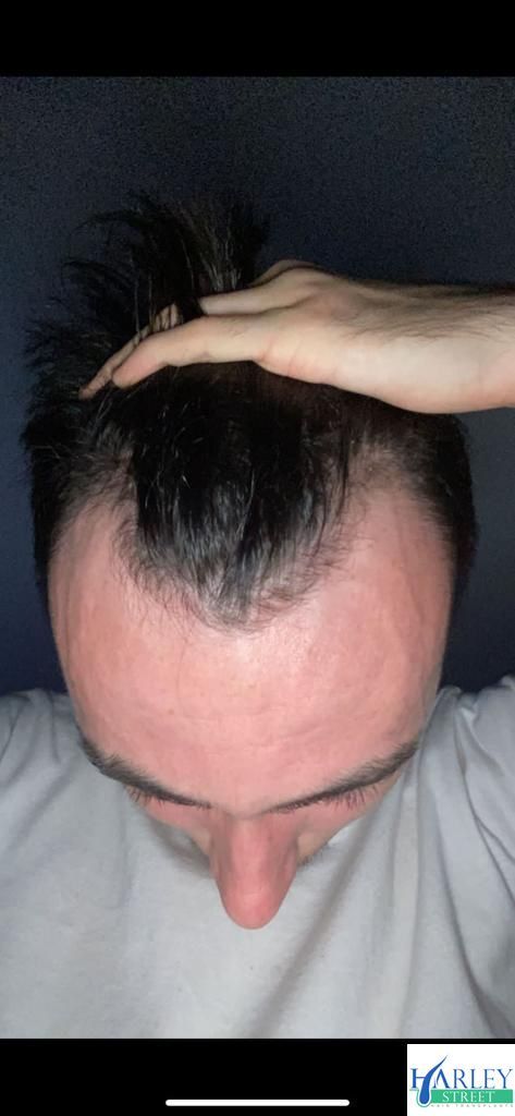 A picture of a hair transplant Manchester patient showing signs of male pattern baldness
