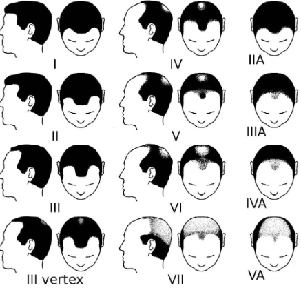 A diagram of the Norwood Scale