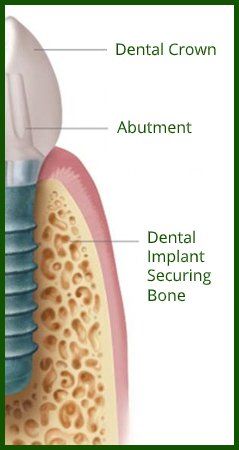 Structure of Dental Implants