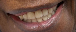 After Dental Implants